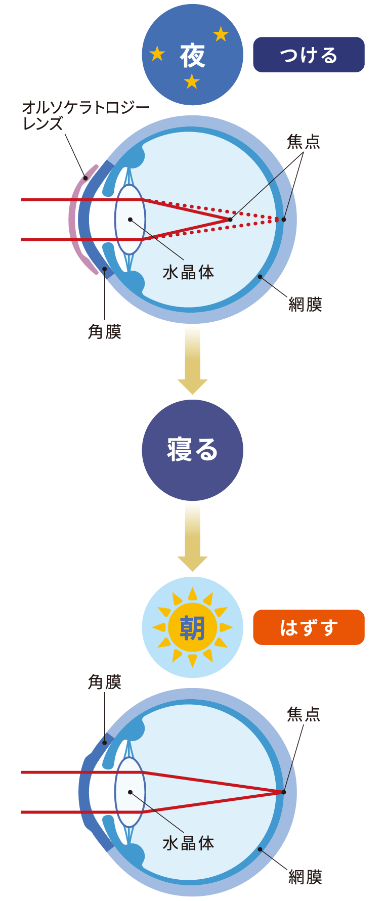 オルソケラトロジーによる近視矯正の仕組みを表す図