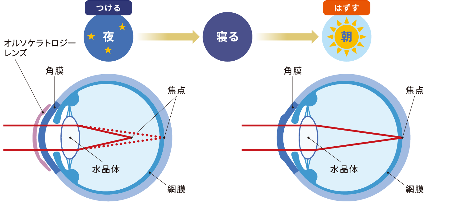 オルソケラトロジーによる近視矯正の仕組みを表す図